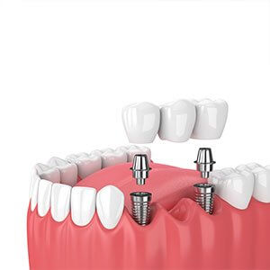 Dental Bridges in Turkey