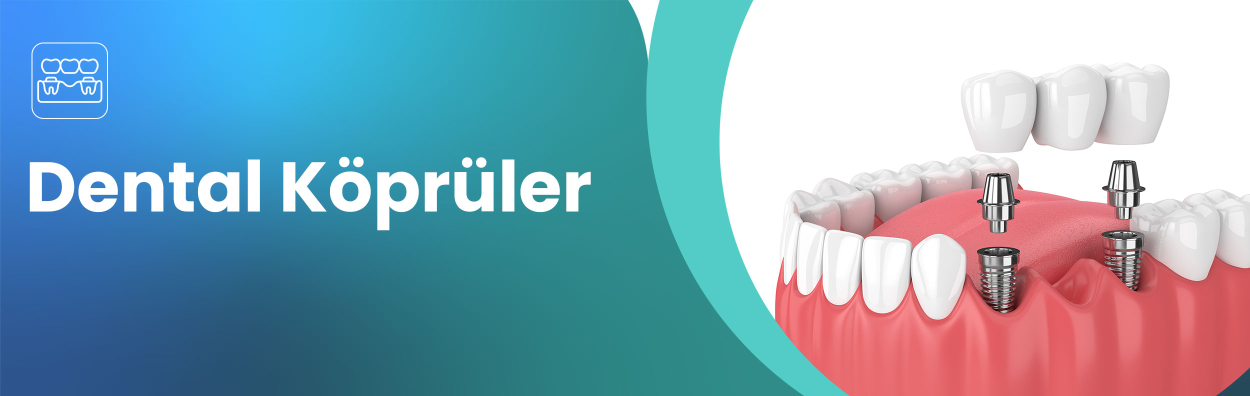 dental-kopruler