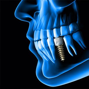 Dental Implants Turkey