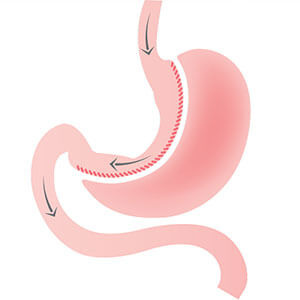 Sleeve Gastrectomy Surgery Turkey 