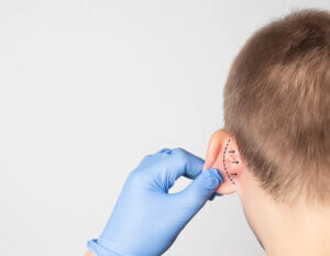 ear pinning