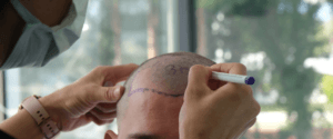 dhi hair transplant