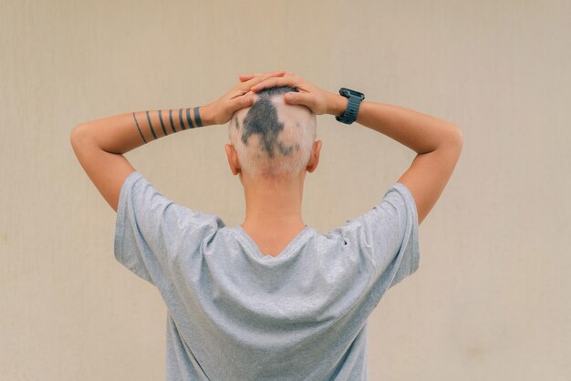 Hair Transplant Operations Turkey Istanbul Before After Cost 34