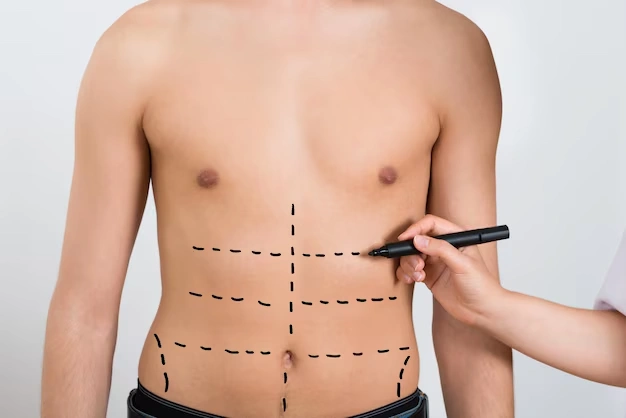 Body Contouring for Men: Abs and Chest Sculpting Explained 3 body aesthetic surgeries Turkey Istanbul Cost 23