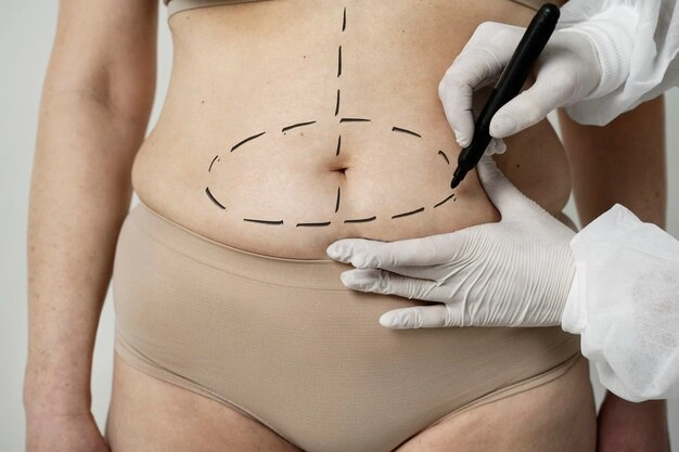 Extended Tummy Tuck: When You Need Extra Tightening 1 body aesthetic surgeries Turkey Istanbul Cost 45
