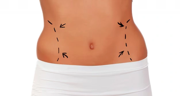 How to Fix Uneven Abdomen After Tummy Tuck 2 body aesthetic surgeries Turkey Istanbul Cost 86