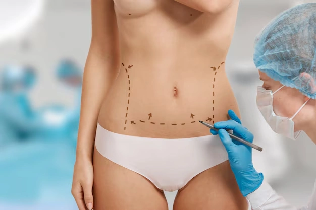 What to Expect from a 360-Degree Liposuction 3 body aesthetic surgeries Turkey Istanbul Cost 88