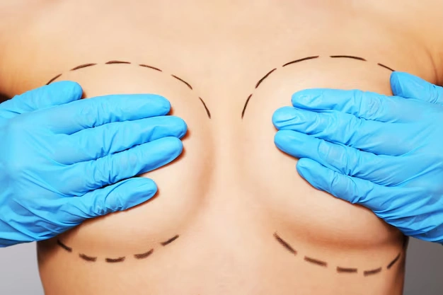 How to Get Symmetrical Breasts After Surgery 10 breast aesthetic surgeries Turkey Istanbul Cost 54