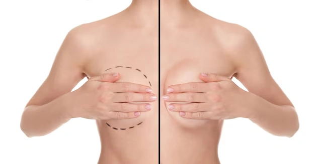 Breast Reduction Scars: How to Minimize and Treat Them 6 breast aesthetic surgeries Turkey Istanbul Cost 7 1