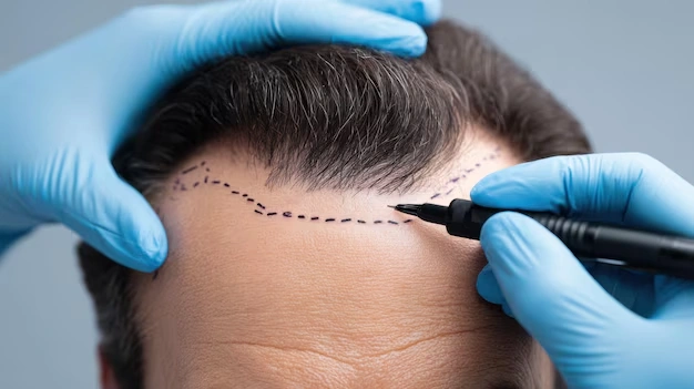 Hair Transplant Operations Turkey Istanbul Before After Cost 25